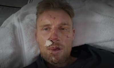 Flintoff shows the extent of his injuries shortly after the crash. Pic: BBC