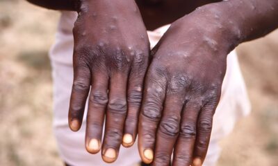 Monkeypox: WHO, Africa’s CDC declare mpox a public health emergency.