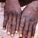 Monkeypox: WHO, Africa’s CDC declare mpox a public health emergency.