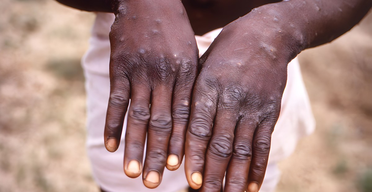 Monkeypox: WHO, Africa’s CDC declare mpox a public health emergency.